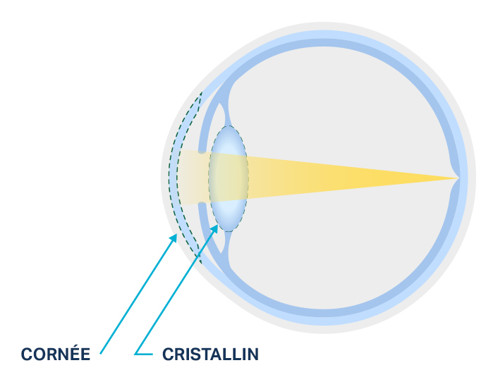 Figure représentant un cristallin sain et un cristallin atteint de cataracte